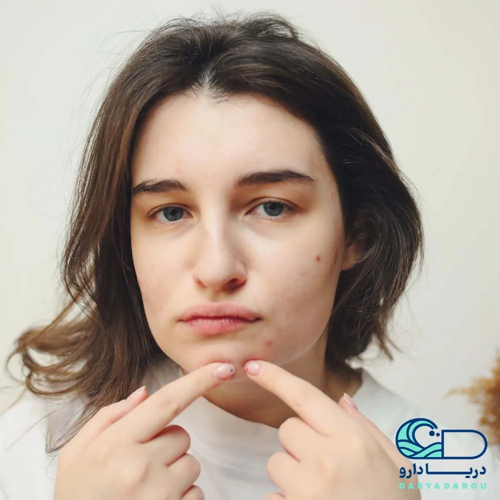 پروبیوتیک برای جوش و آکنه